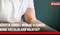 Vücutta sürekli morluk oluşması hangi hastalıkların belirtisi?