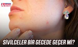 Sivilceler bir gecede geçer mi?