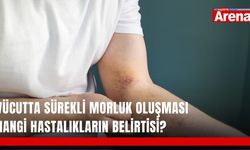 Vücutta sürekli morluk oluşması hangi hastalıkların belirtisi?