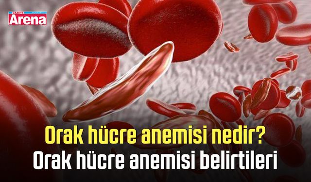 Orak hücre anemisi nedir? Orak hücre anemisi belirtileri