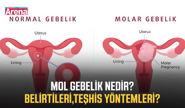 Mol gebelik nedir? Belirtileri, teşhis yöntemleri nelerdir?