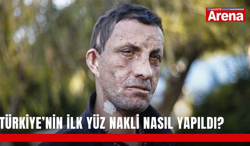 Türkiye’nin ilk yüz nakli nasıl yapıldı?