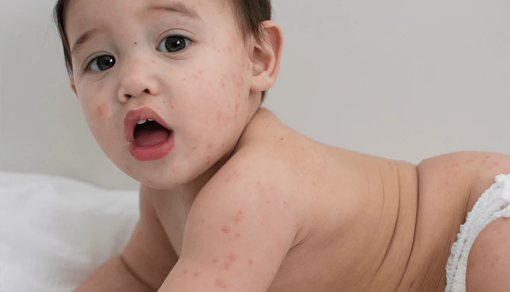 El Ayak Agiz Hastaliginin Belirtileri Nelerdir 1024 X586 P X 1024X1024