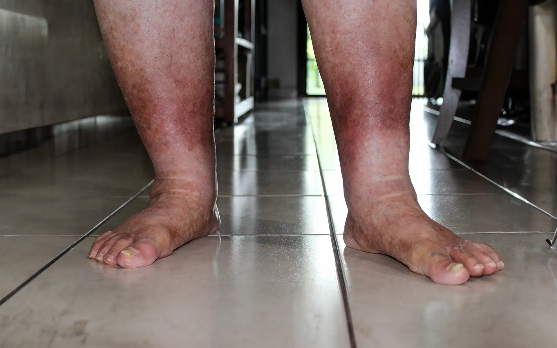 Venoz Yetmezlik Nedir