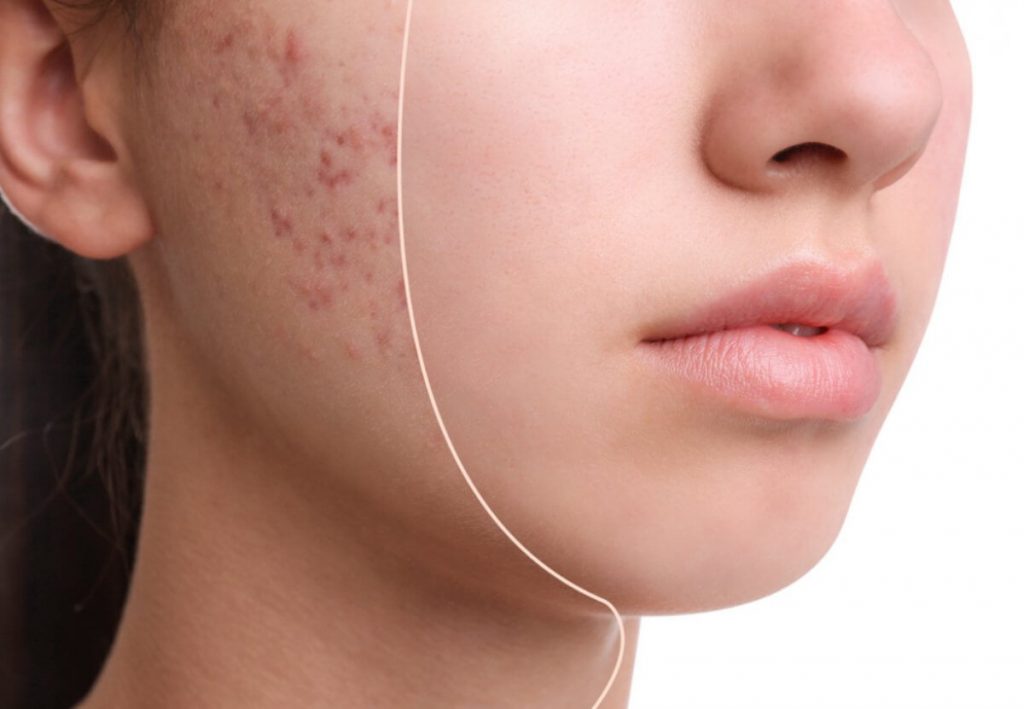 Akne Vularis 1