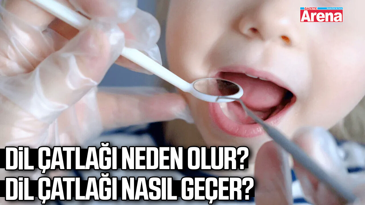 Dil çatlağı neden olur? Dil çatlağı nasıl geçer?