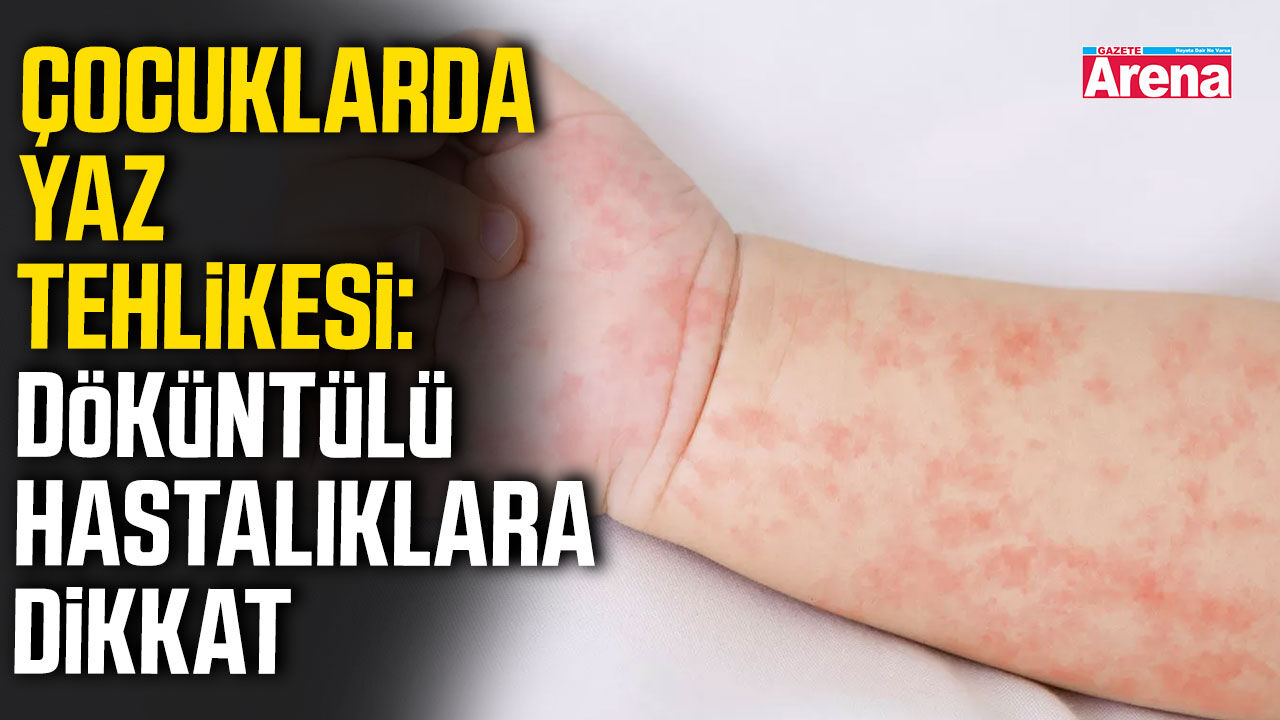 Çocuklarda yaz tehlikesi: Döküntülü hastalıklara dikkat!