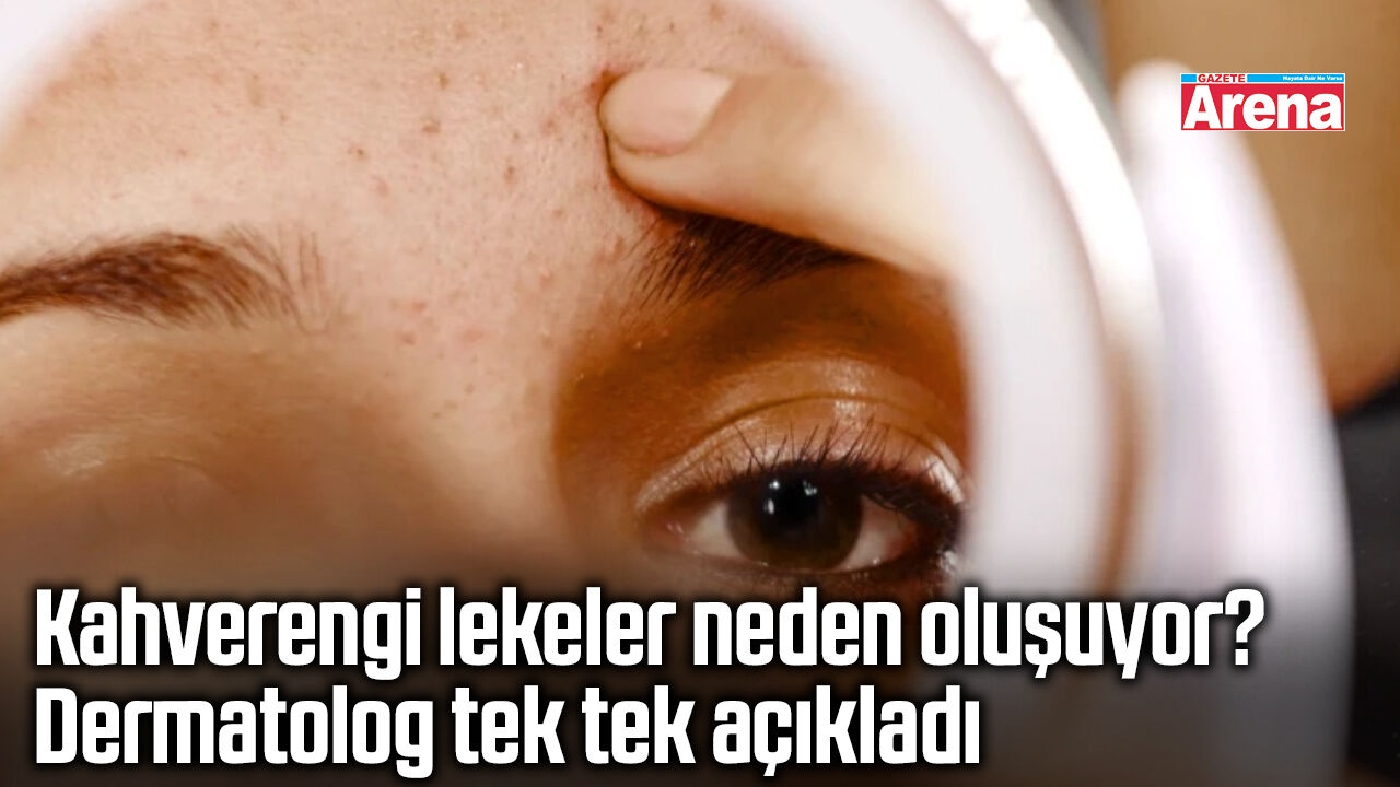 Kahverengi lekeler neden oluşuyor? Dermatolog tek tek açıkladı